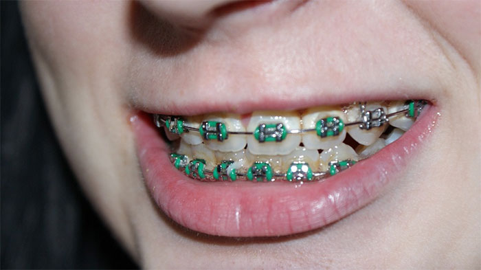 how to take care of braces at school